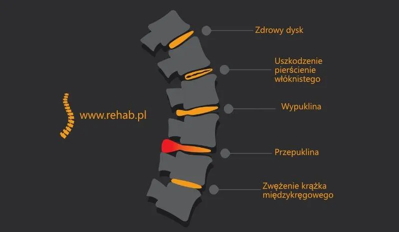 Bezpieczeństwo biegania z dyskopatią