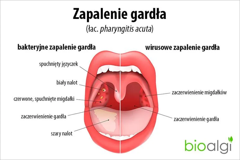 Ból gardła a bieganie