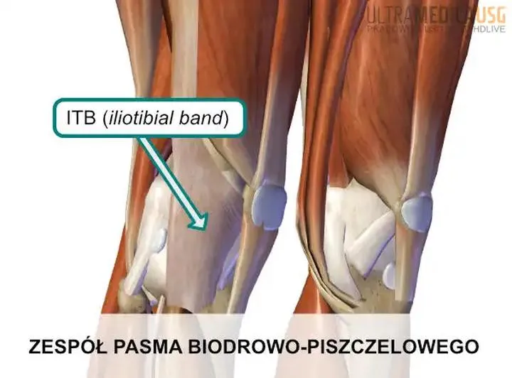 Ból kolana po bieganiu